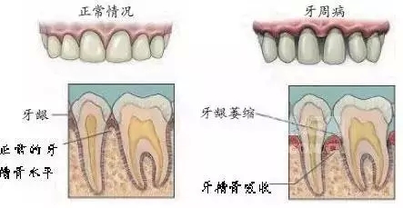 由于牙周组织被破坏,特别是牙槽骨吸收加重时,支持牙齿力量不足