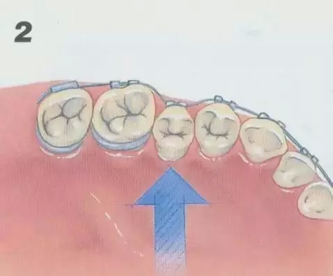 正畸矫正牙齿的基本原理图示